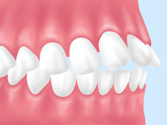 【上顎前突（じょうがくぜんとつ）】